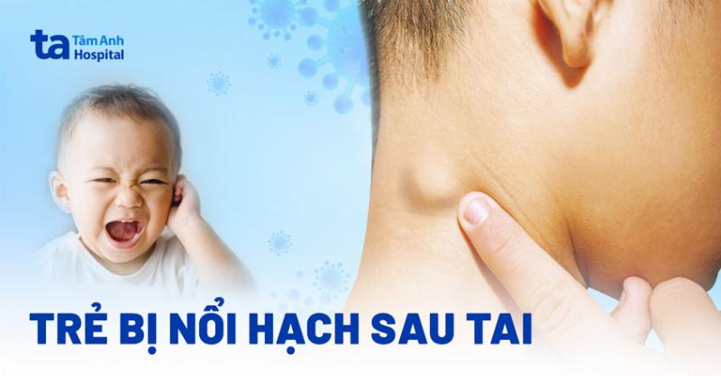 Bé Nổi Hạch Sau Tai: Khi Nào Nên Lo Lắng và Cách Xử Lý Đúng?